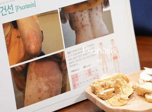 생기한의원 건선 관리, 생활 속 피부 자극 줄이는 방법